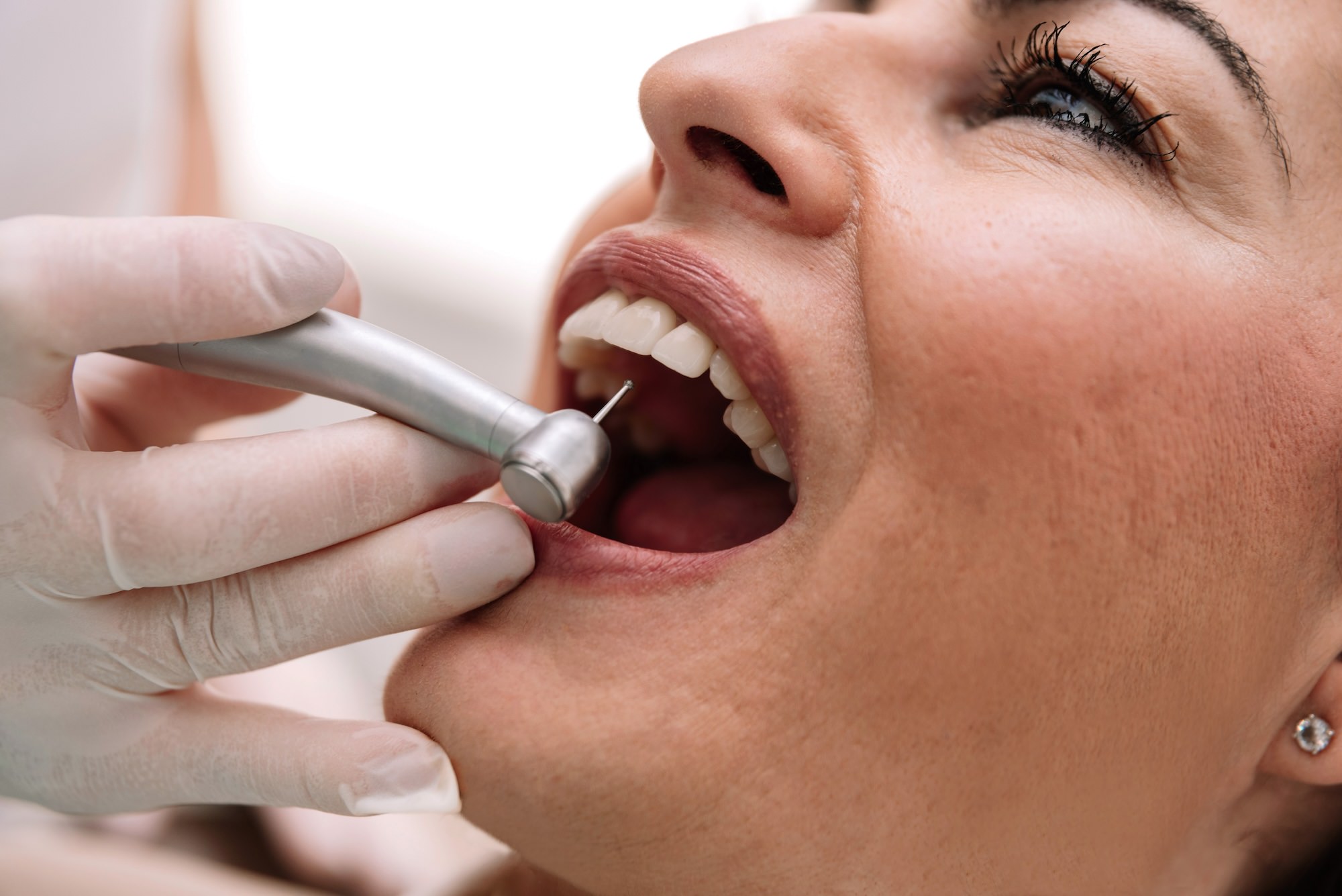 limpieza dental profesional